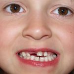 علل پوسیدگی دندان های شیری